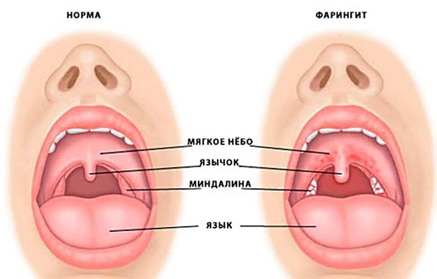 Фарингит