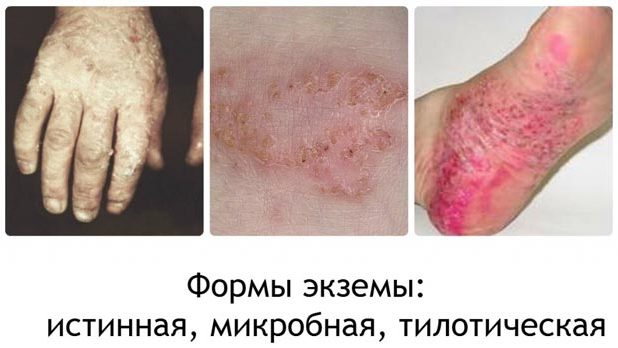 Формы экземы 