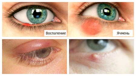 Симптомы ячменя на глазах