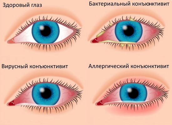 Симптомы конъюнктивита