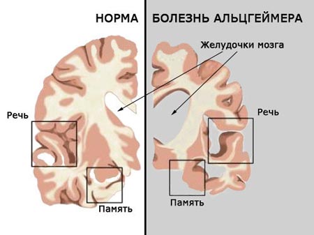 Болезнь Альцгеймера