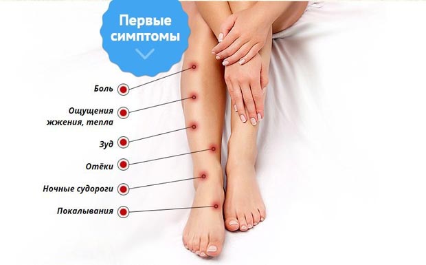 Симптомы варикоза