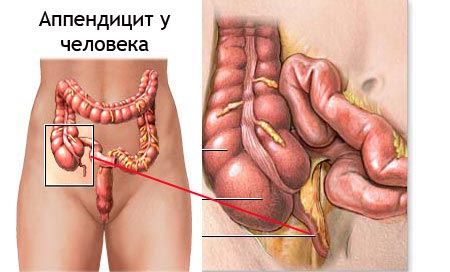 Аппендицит у человека
