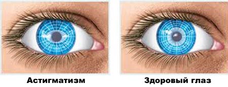 Здоровый глаз и астигматизм