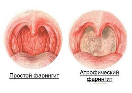 Атрофический фарингит