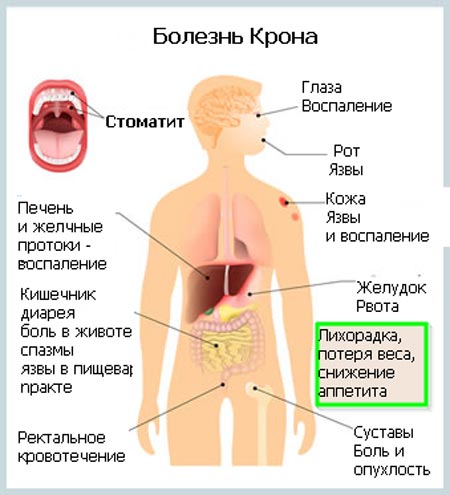 Симптомы болезни Крона