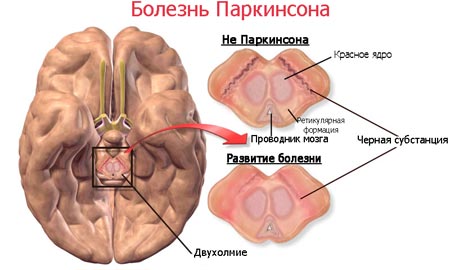 Болезнь Паркинсона