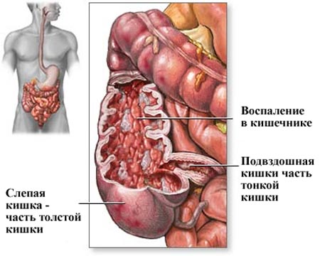 Болезнь Крона