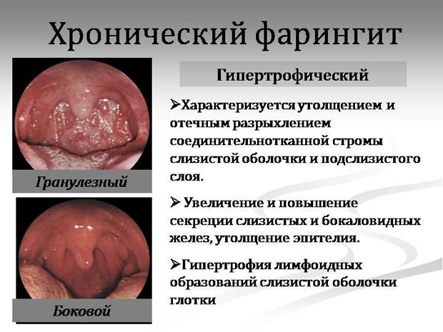 Хронический фарингит