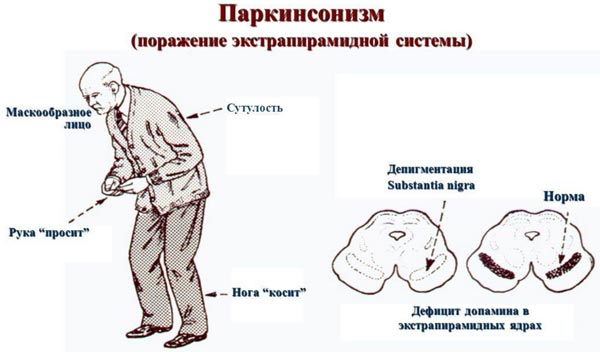 Симптомы Паркинсонизма