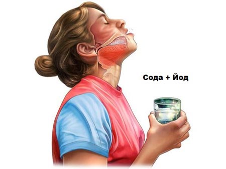 Полоскание горла содой и йодом 