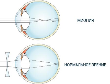 Нормальное зрение и миопия