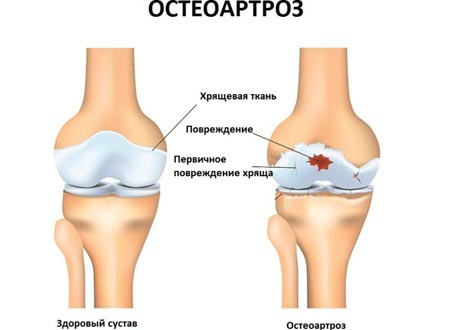 Остеоартроз