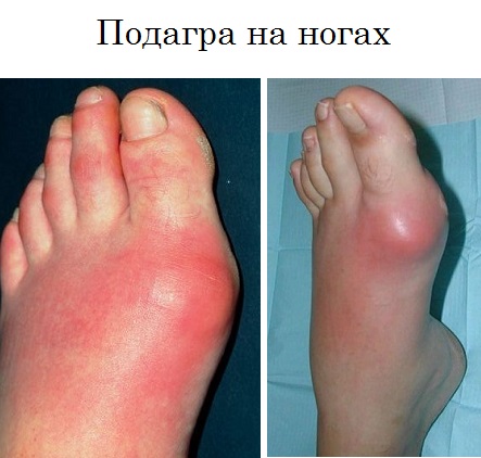 Подагра на ногахх