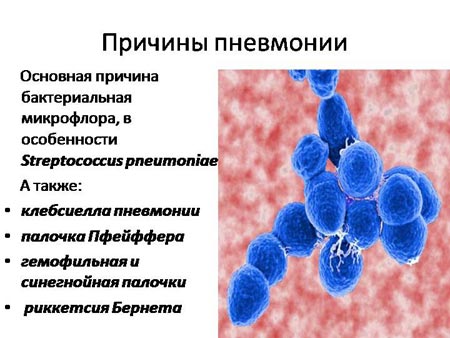 Причины пневмонии 
