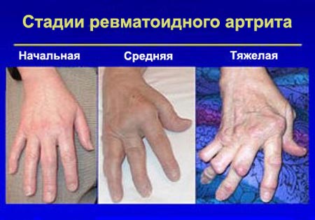 Стадии ревматоидного артрита пальцев рук