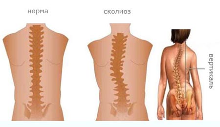 Сколиоз