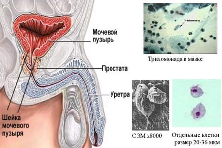 Трихомониаз
