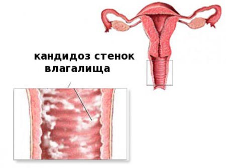 Вагинальный кандидоз