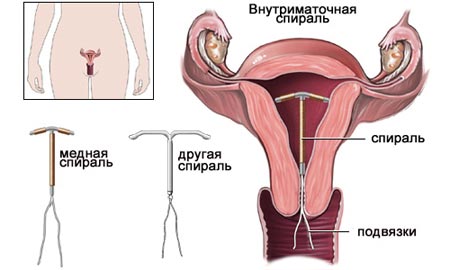 Причина эндометрии