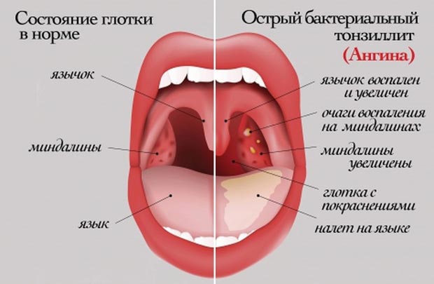 Ангина