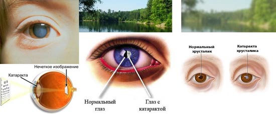 Глаз с катарактой
