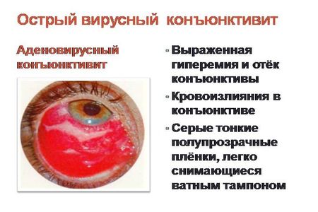 Аденовирусный конъюнктивит