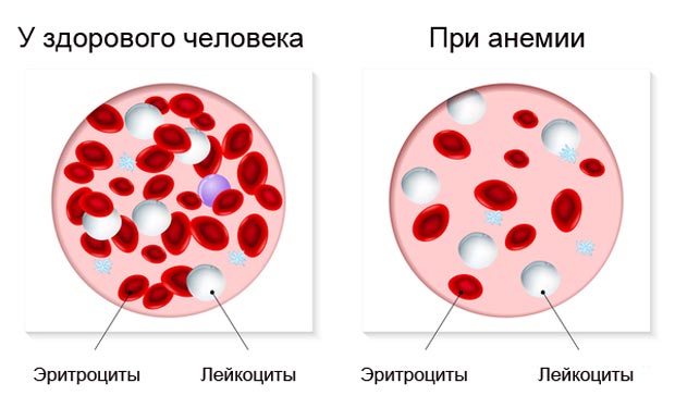 Анемия клетки крови