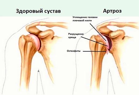 Здоровый сустав и артроз 