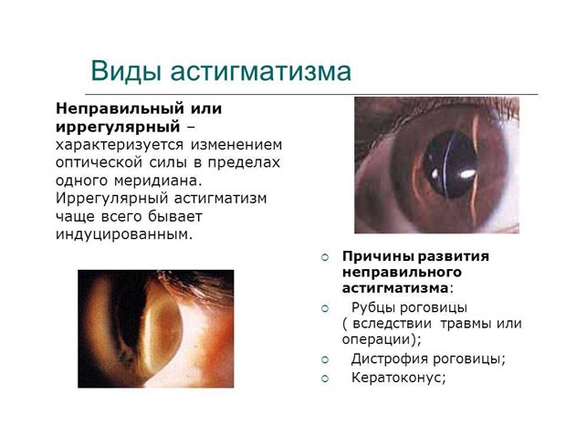 Виды астигматизма