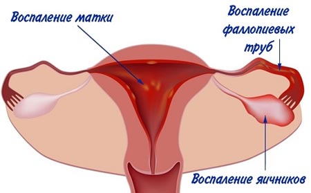 Воспалительные процессы в матке