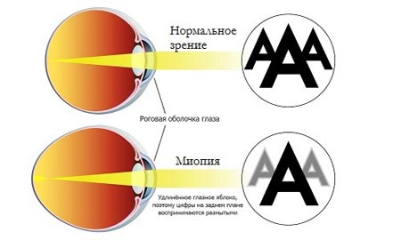 Миопия