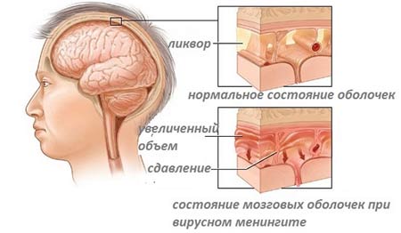 Менингит
