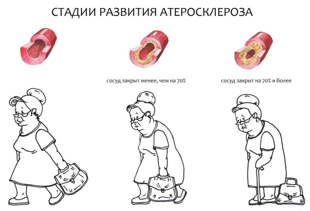 Стадии развития атеросклероза