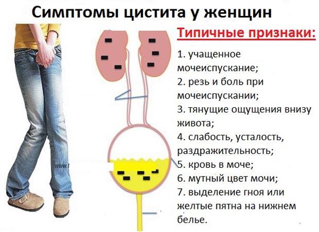 Симптомы цистита у женщин 