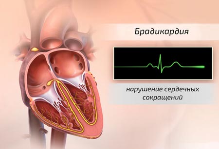 Брадикардия