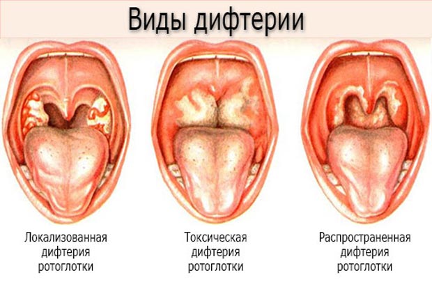 Виды дифтерии 