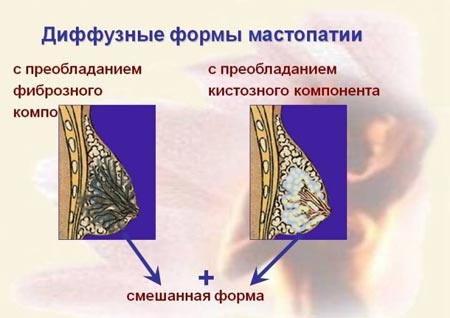 Диффузная мастопатия
