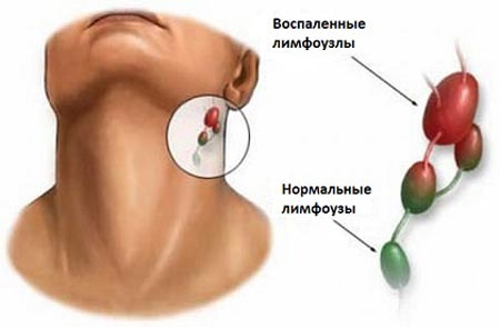 Дифтерия и лимфоузлы