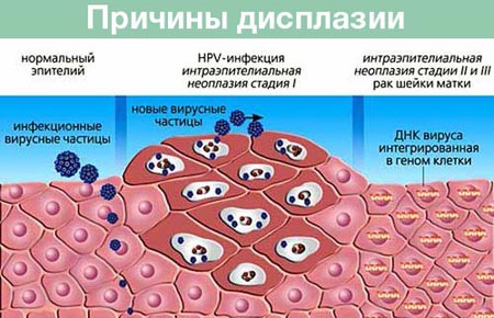 Причины дисплазии