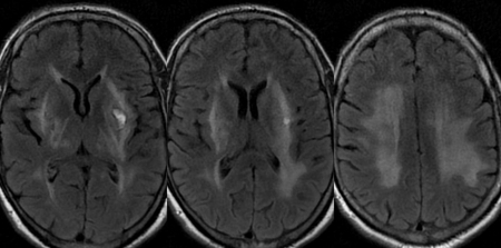 Энцефалопатия