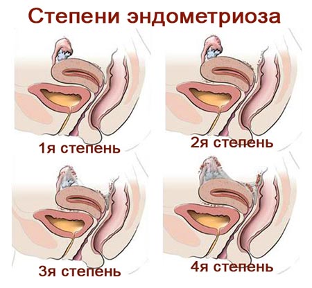 Степени эндометриоза