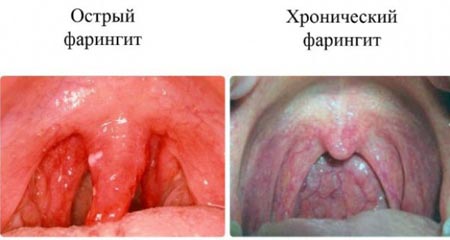 Острый и хронический фарингит