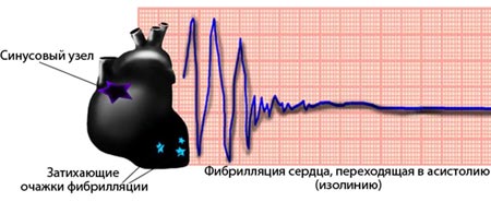 Фибрилляция желудочков сердца