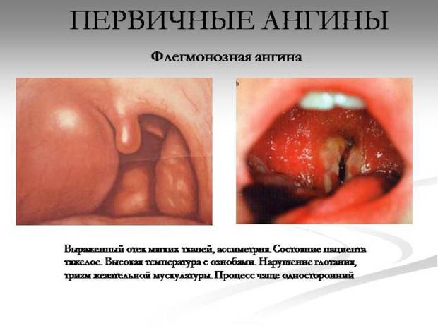 Признаки флегмонозной ангины