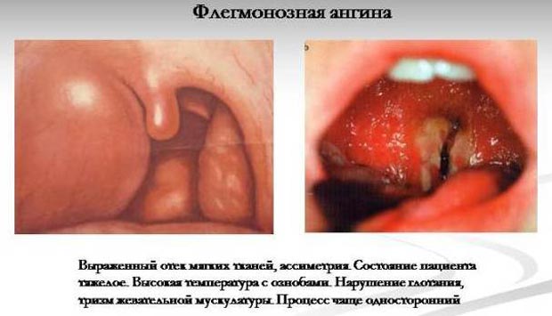 Флегмонозная ангина