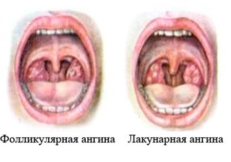 Фолликулярная ангина