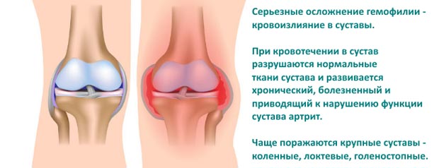 Осложнения гемофилии 
