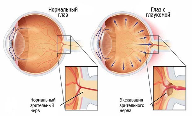 Глаз с глаукомой