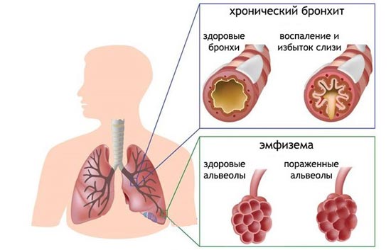 Бронхит курильщика